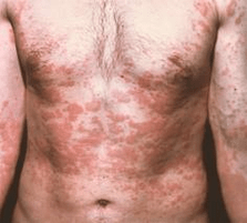 a pel problemática é un síntoma da presenza de parasitos