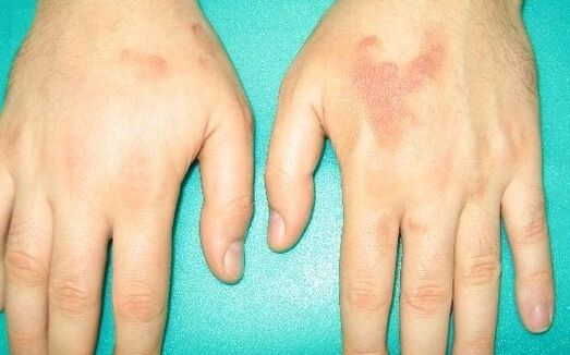 dor nas articulacións das mans pode ser síntomas de parasitos