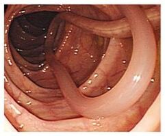 parasitos no corpo humano