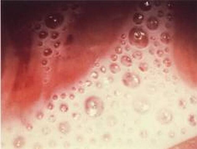 descarga de burbullas con parasitos protozoarios