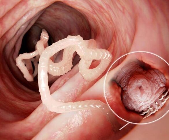 vermes no intestino humano foto 2
